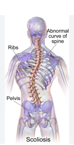 scoliosis